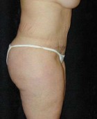Tummy Tuck Patient 19073