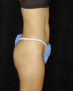 Tummy Tuck Patient 93920 After Photo # 2