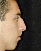 Nose Surgery Patient 54546