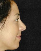 Nose Surgery Patient 53618