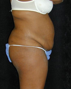 Tummy Tuck Patient 23409 Before Photo # 1