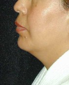 Chin Surgery Patient 16456