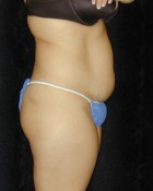 Tummy Tuck Patient 79254