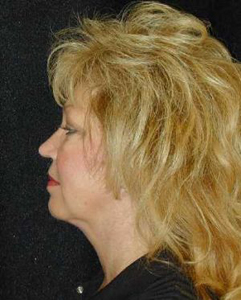 Patient # 63504 After Photo # 2