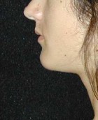 Chin Surgery Patient 92696