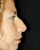 Nose Surgery Patient 99917