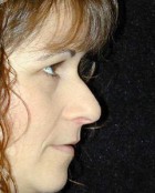 Nose Surgery Patient 63726