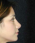 Nose Surgery Patient 86926