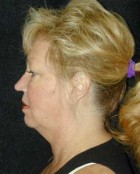 Patient # 63504 Before Photo Thumbnail # 1
