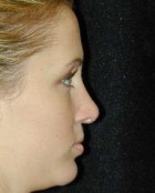 Nose Surgery Patient 99542