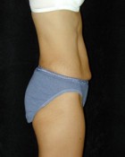 Tummy Tuck Patient 93920