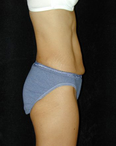 Tummy Tuck Patient 93920 Before Photo # 1