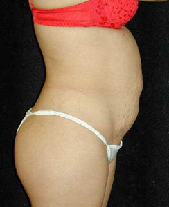 Tummy Tuck Patient 92595 Before Photo # 1