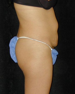 Tummy Tuck Patient 11716 Before Photo # 1