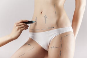 Liposuction