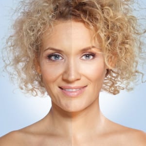 Laser Skin Resurfacing