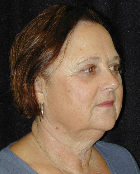 Patient # 37413 Before Photo # 3