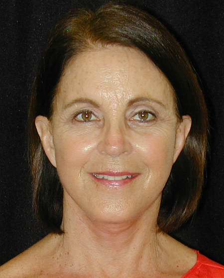 Patient # 48332 After Photo # 2