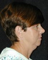 Patient # 22072 Before Photo Thumbnail # 5