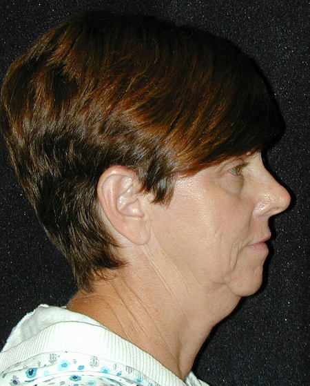 Patient # 22072 Before Photo # 5