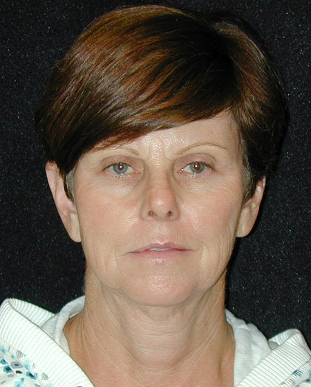 Patient # 22072 Before Photo # 1