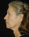 Patient # 20394 Before Photo Thumbnail # 5