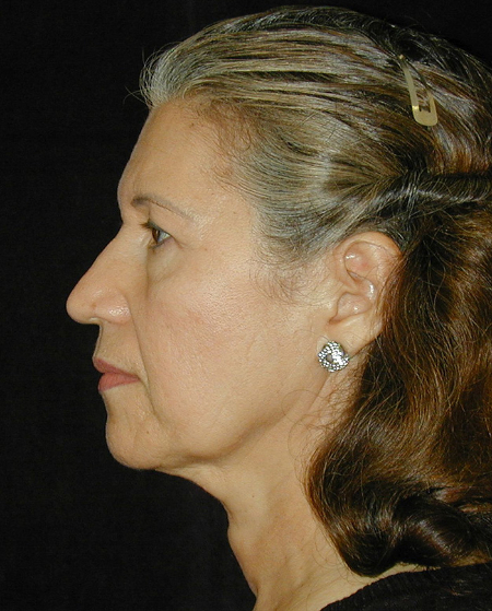 Patient # 20394 Before Photo # 5