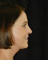 Patient # 48332 After Photo Thumbnail # 6