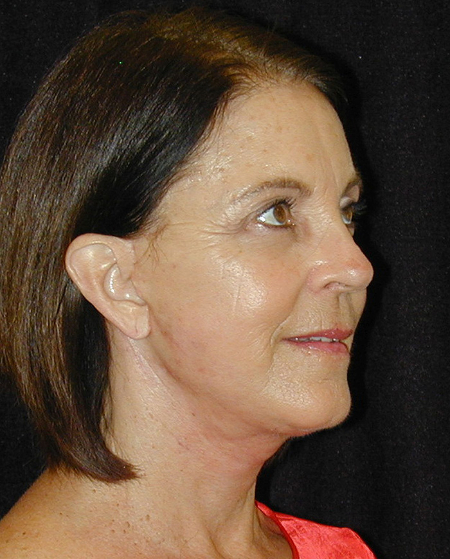 Patient # 48332 After Photo # 4