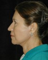 Patient # 20394 After Photo Thumbnail # 6