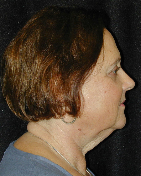 Patient # 37413 Before Photo # 5