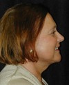 Patient # 37413 After Photo Thumbnail # 6