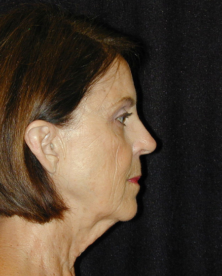 Patient # 48332 Before Photo # 5