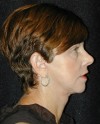 Patient # 22072 After Photo Thumbnail # 6