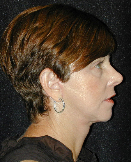 Patient # 22072 After Photo # 6