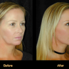 Dr. Ip Facelift Patient