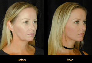 Dr. Ip Facelift Patient