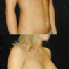 Ip Breast Augmentation Patient