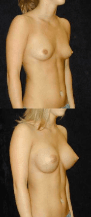 Ip Breast Augmentation Patient