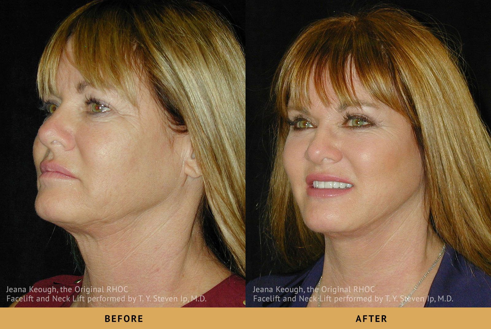 jeana keough real housewives of RHOC Facelift and Necklift Surgery Left Oblique View