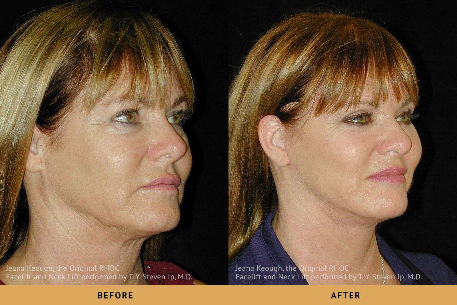 jeana keough real housewives of RHOC Facelift and Necklift Surgery right Oblique View