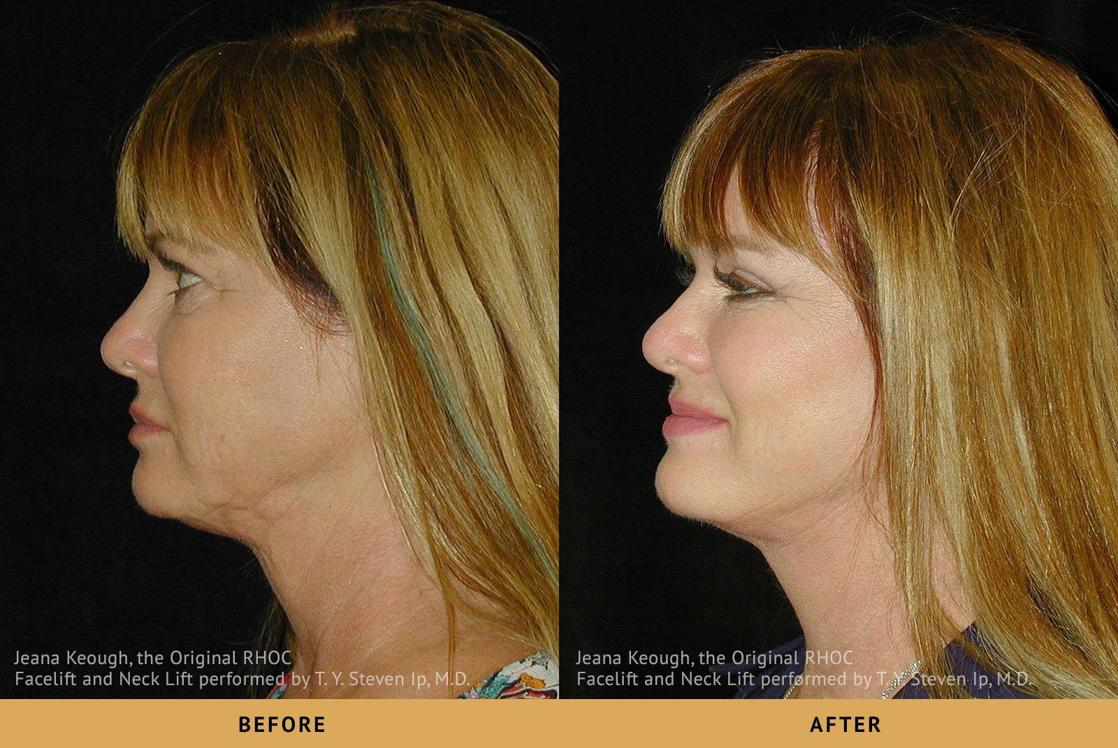 jeana keough real housewives of orange county RHOC Facelift and Necklift Left Profile View