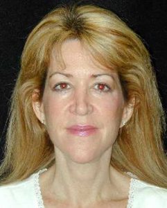 Case--3896 | After Face Lift and Neck Lift 1