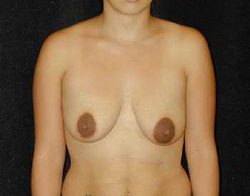 Case--7796 | Before Breast Lift 1