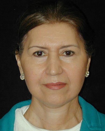 Case--9197 | After Face Lift and Neck Lift 1