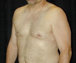Case--6679 | After Male Breast Reduction 1
