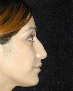 Case--8353 | Before Nose Surgery 1