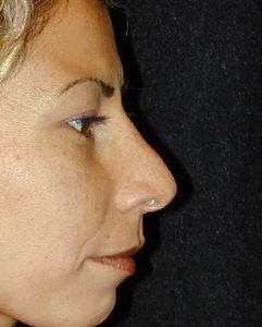 Case--1481 | After Nose Surgery 1