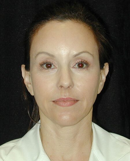 Case--4340 | Before Face Lift and Neck Lift 1