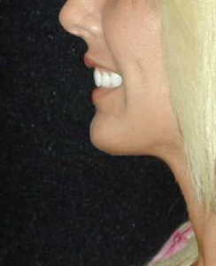 Case--6851 | After Chin Surgery 1